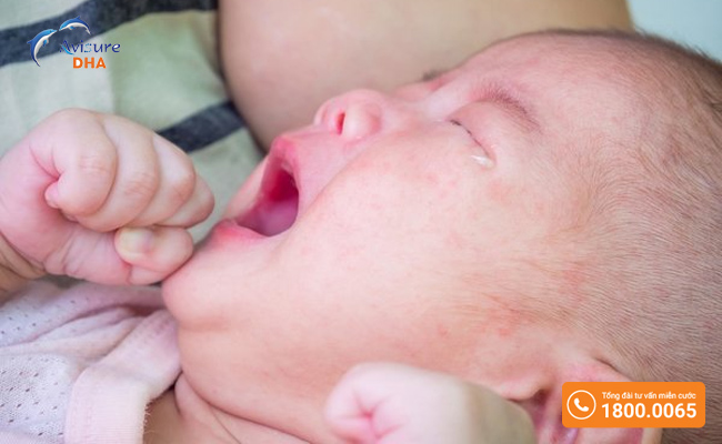 Trẻ sơ sinh bị sôi bụng do dị ứng với sữa mẹ
